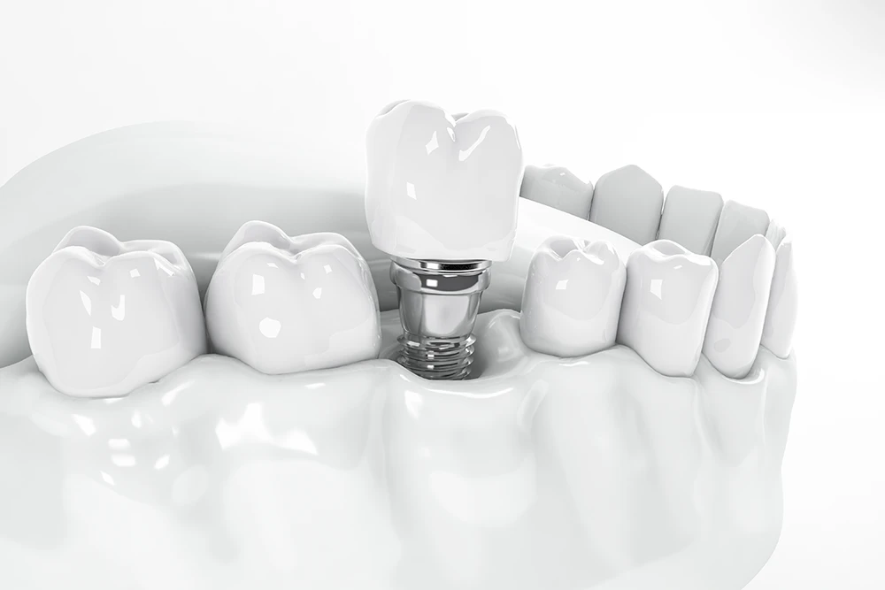 Illustration of Single Dental Implant